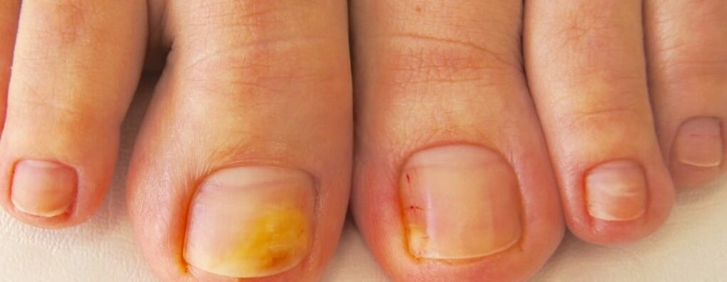ciuperca micelială pe unghiile picioarelor